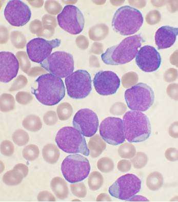 Combined therapy shows promise for chronic lymphocytic leukemia