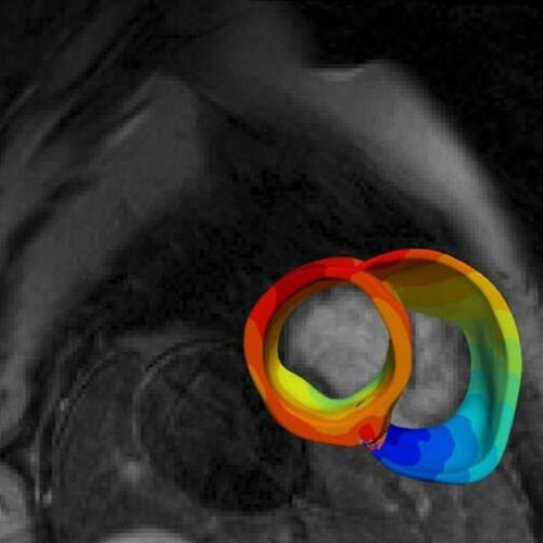 New tool predicts sudden death in inflammatory heart disease