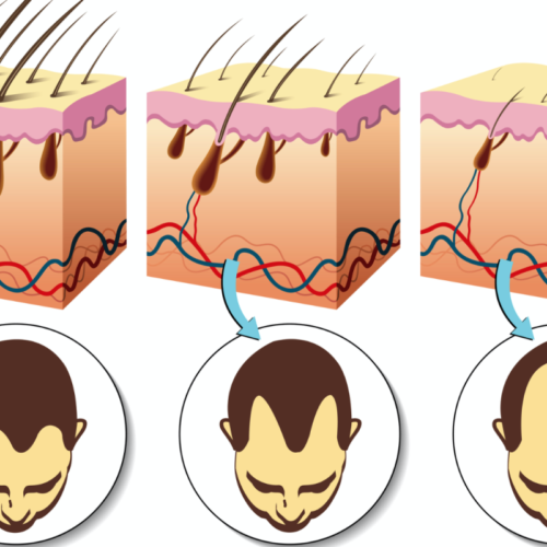 Microneedle patch beats baldness by boosting blood flow to the follicles