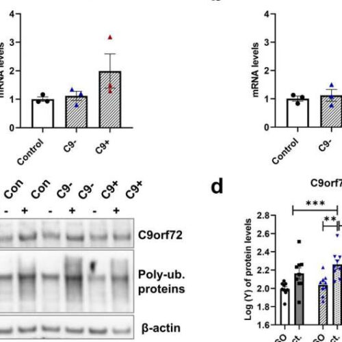 Skin cells from frontotemporal dementia patients may reveal disease mechanisms and biomarkers for drug research