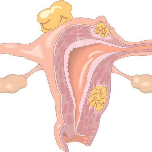 Researchers identify genetic cause of endometriosis and reveal potential drug target