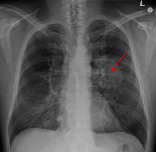 Adoptive cell therapy plus checkpoint inhibitors show promise in non-small cell lung cancer