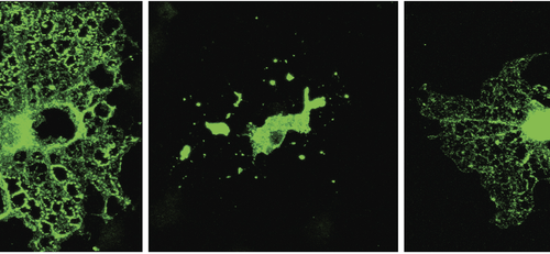 Researchers link neurodegenerative disease protein to defective cholesterol metabolism