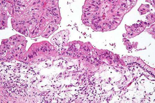 Ovarian cancer: Potential therapeutic target identified