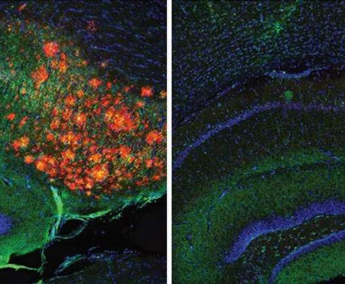 Brain cholesterol regulates Alzheimer’s plaques, study reveals