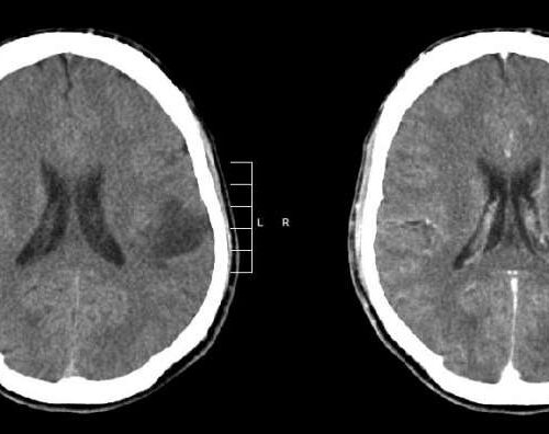 Uncovering epigenetic mechanisms regulating glioma growth