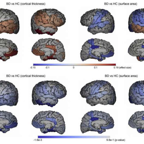 Manic episodes in bipolar disorder linked to abnormal brain changes