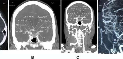 New screening tool identifies people at risk of aneurysms