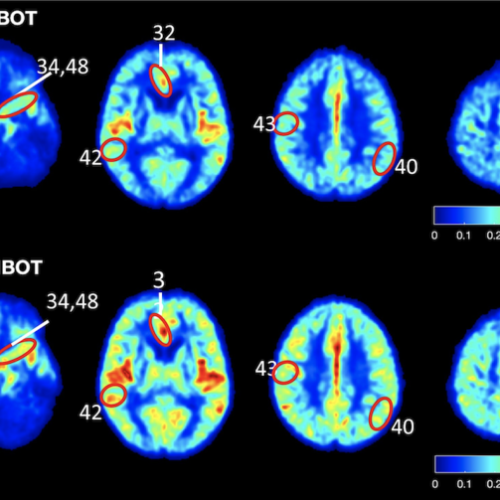 Reversal of the biological hallmarks responsible for development of Alzheimer’s disease and dementia using unique hyperbaric oxygen therapy protocol