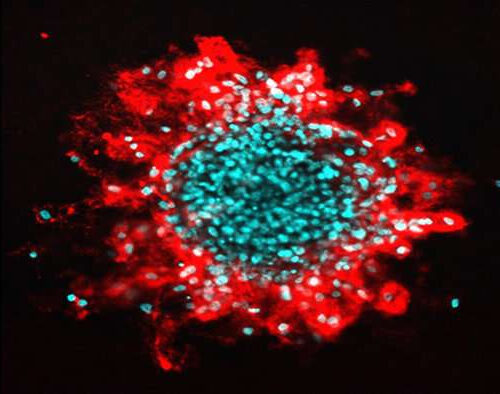 Ruptures in cell nuclei promotes tumor invasion in breast cancer