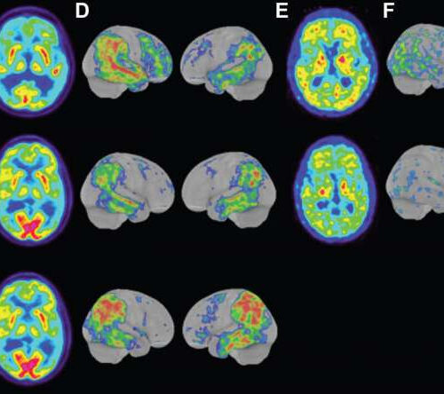 Scientists in Sweden discover a rare, aggressive form of Alzheimer’s that begins in the early 40s