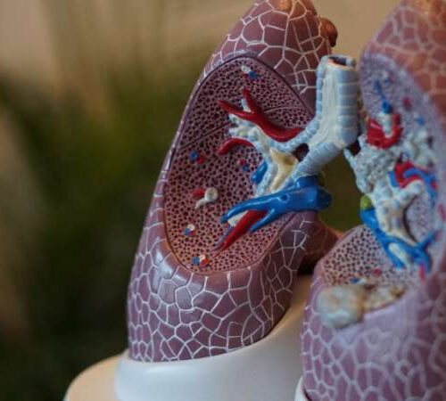 Study: Long-term disabilities linked to TB