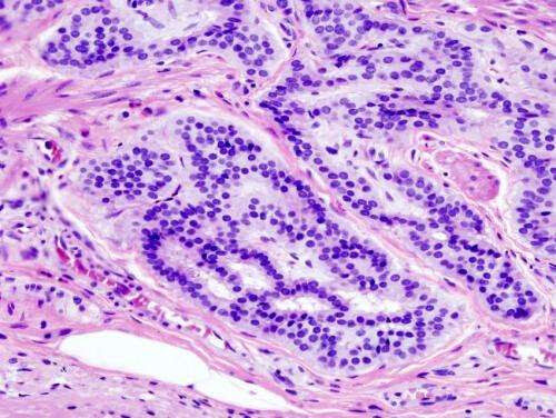 Study: Colon cancer risk extends to second- and third-degree relatives