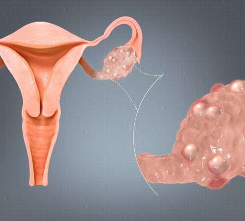 Treating polycystic ovary syndrome costs $8 billion a year in US alone