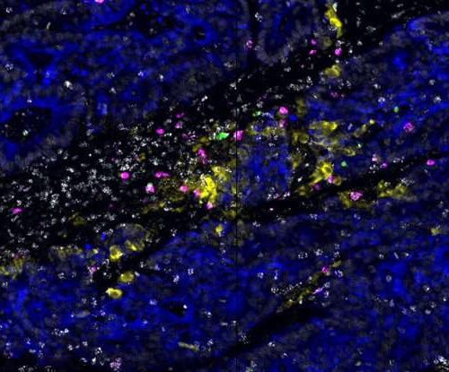 Immune cell ‘hubs’ discovered hiding in tumors