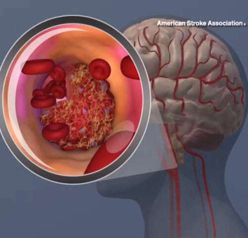 Naturally occurring protein to block inflammatory response improved stroke recovery in mice