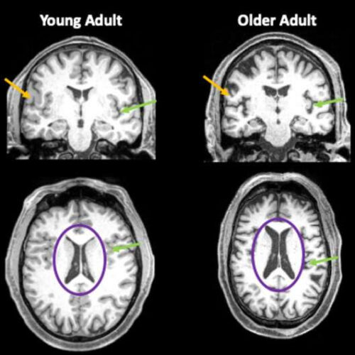 Preliminary research finds that even mild cases of COVID-19 leave a mark on the brain