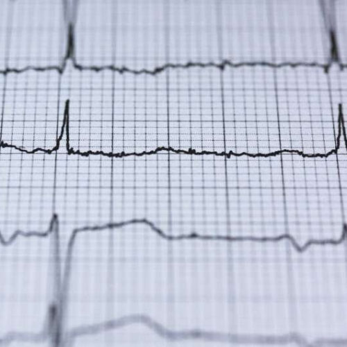 Sex drug can strongly suppress abnormal heart rhythms, finds study