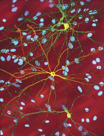New study puts focus on early symptoms of Huntington’s disease