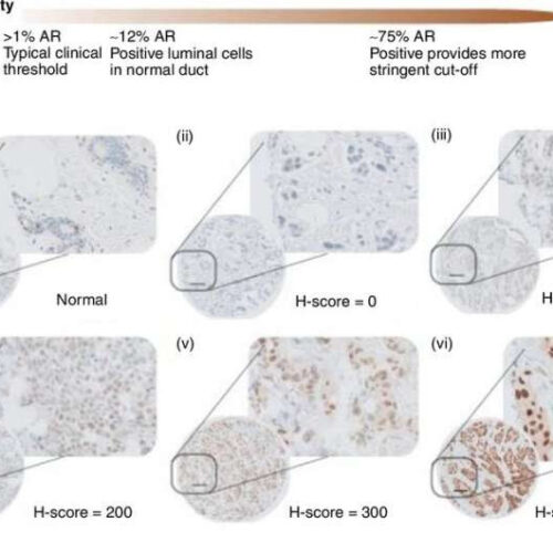 Hormone profiling could be used to improve survival rates for breast cancer