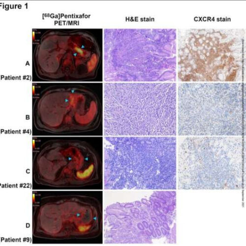 New imaging method for the detection of gastric lymphomas