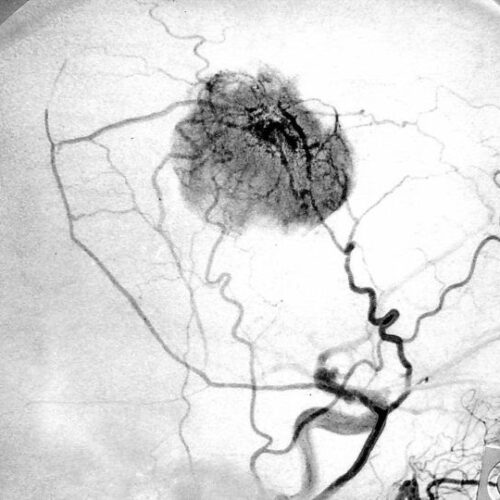 Doctors should operate meningiomas even in elderly patients