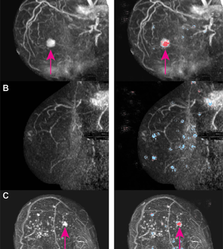 AI helps rule out cancer in dense breasts