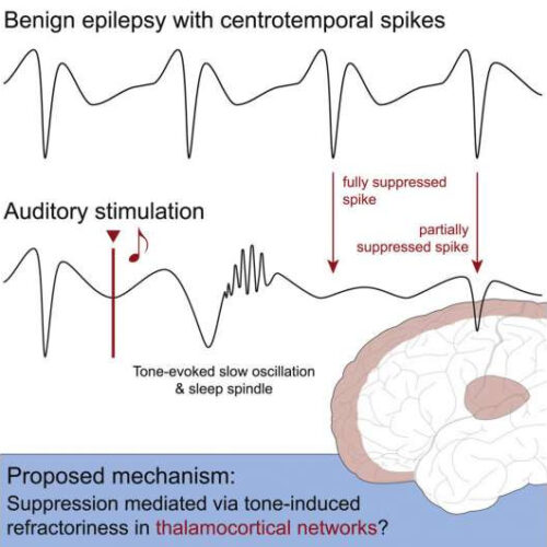 Disordered brain activity in Rolandic epilepsy can be influenced by brief sounds during sleep