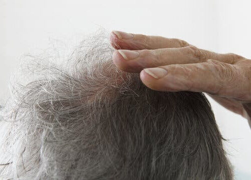 Losing Your Hair? You Might Blame the Great Stem Cell Escape