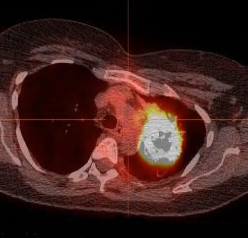 Most cases of never-smokers’ lung cancer treatable with mutation-targeting drugs