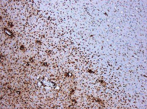 Multiple sclerosis: The link with earlier infection just got stronger