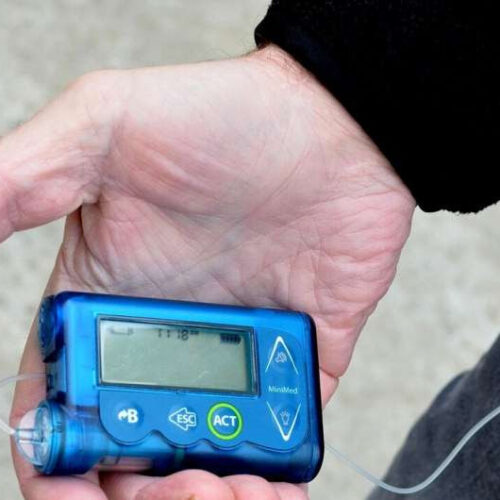 Study: Youths who use insulin pumps less at risk for diabetic retinopathy