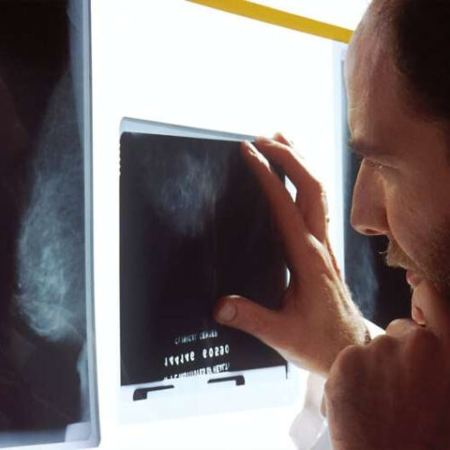 Targeted prostate cancer screening could benefit men with inherited cancer syndrome