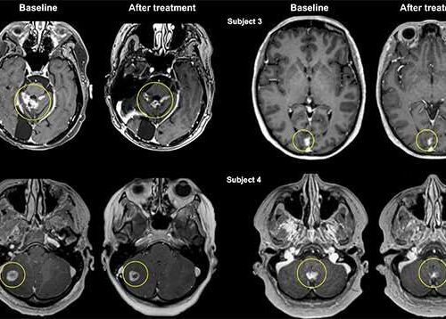 Clinical trial demonstrates focused ultrasound can deliver antibody therapy to breast cancer metastases in the brain