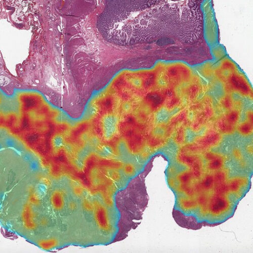 New deep learning algorithm can pick up genetic mutations and DNA mismatch repair deficiency in colorectal cancers more efficiently