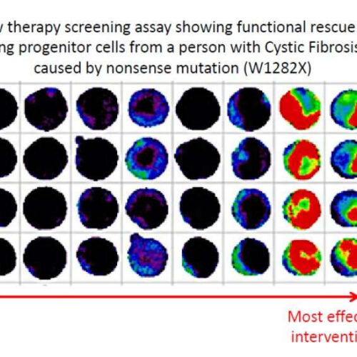 Stem cell study: Cystic fibrosis patients may see personalized treatments emerge from drug screening in a dish