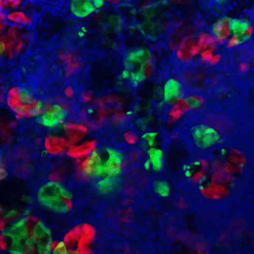 Uncovering how injury to the pancreas impacts cancer formation
