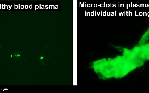 First evidence of inflammatory micro clots in blood of individuals suffering from Long COVID