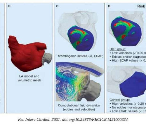 Blood flow simulations may improve the monitoring of atrial fibrillation