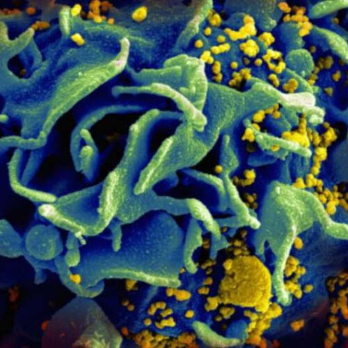 Treatment strategy may lead to HIV cure