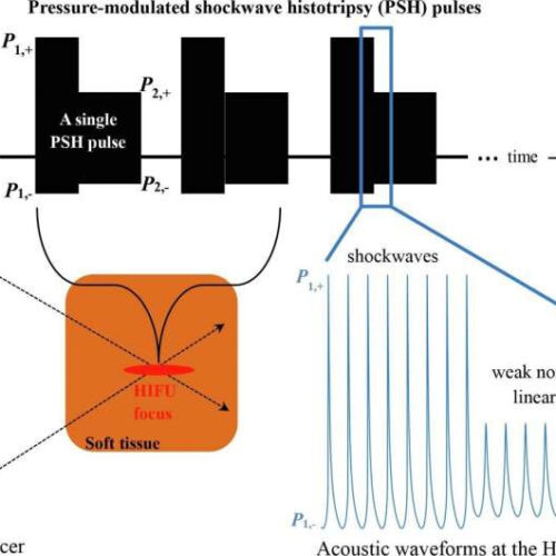 Development of precision focused ultrasound surgery technology that destructs only the desired tissues