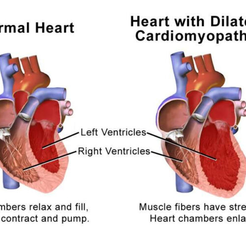 Drug may improve cardiac function in hypertrophic cardiomyopathy