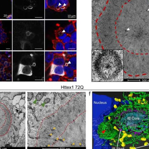 Huntington’s disease: The ultrastructure of huntingtin inclusions revealed