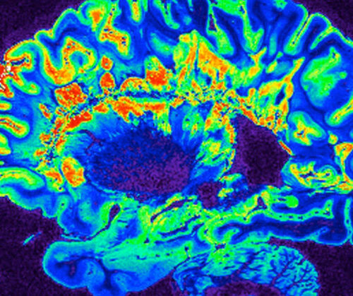 Nasal Alzheimer’s Vaccine To Start Human Trials for the First Time