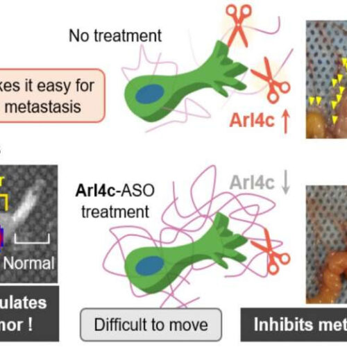 Researchers discover why pancreatic cancer cells are so aggressive