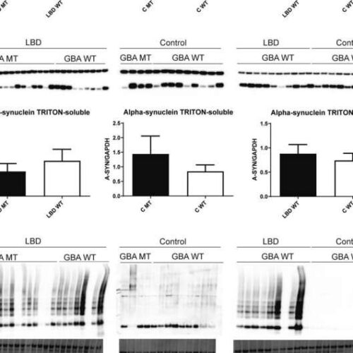 Role of fats and proteins in Lewy Body dementia