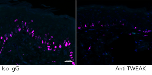 Suffering from psoriasis? Blame this trio of proteins