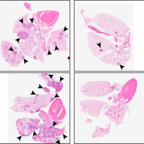 By putting cancer cells to sleep, new drug could prevent tumor metastasis