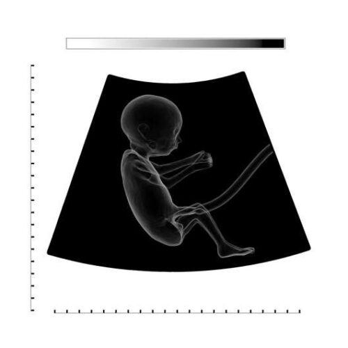 Cannabis use during pregnancy impacts the placenta and may affect subsequent child development