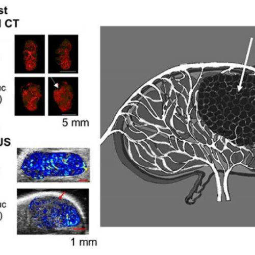 Cancer cells impair blood flow in metastatic lymph nodes